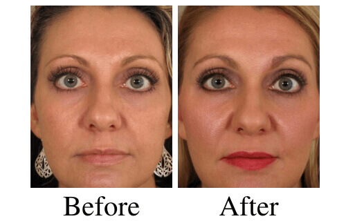 Juvederm and Voluma Before and After