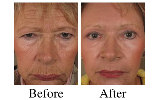 Facial Cosmetic Surgery