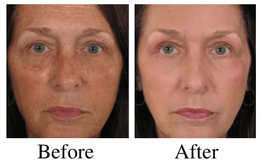 Laser Skin Resurfacing Before and After