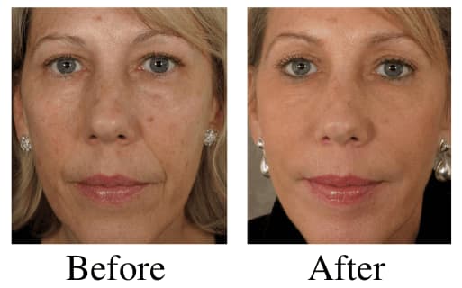 Liquid Facelift Before and After