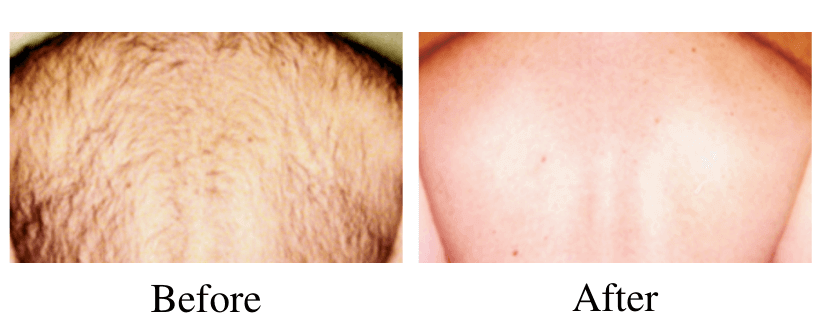 laser hair removal before and after