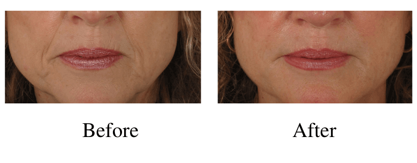 Juvederm before and after