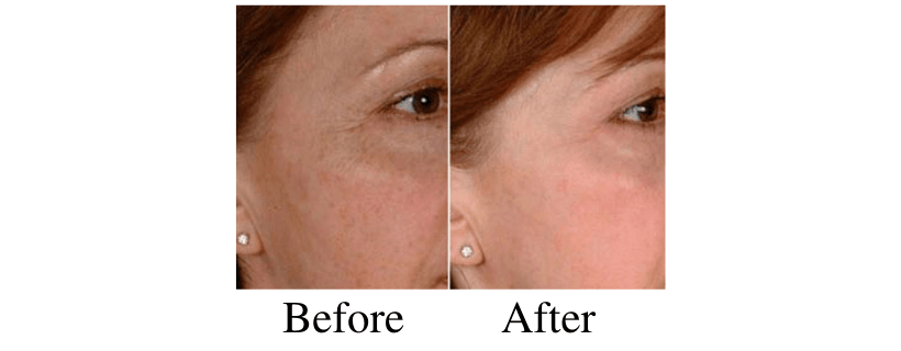 Laser Genesis before and after
