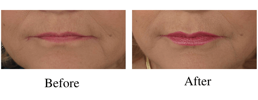 Lip Augmentation before and after