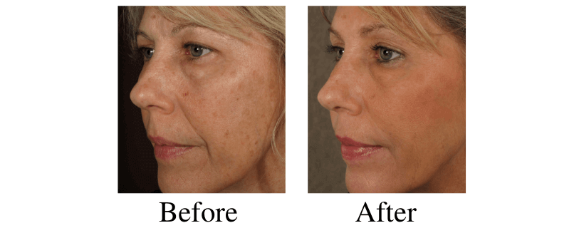 Liquid Facelift before and after