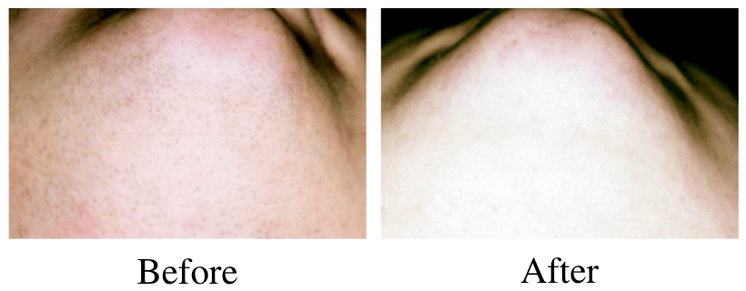 laser hair removal before and after