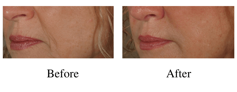 Juvederm before and after