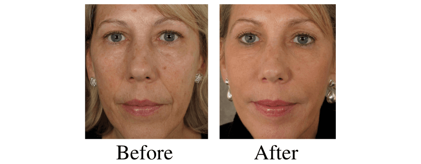 Liquid Facelift before and after