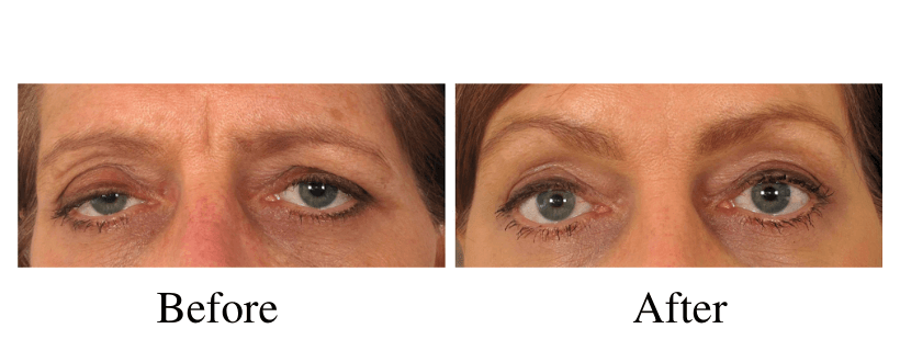 Brow lift before and after