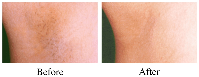 laser hair removal before and after