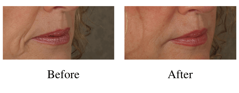 Juvederm before and after