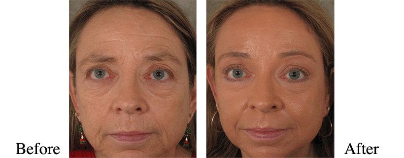 Laser Skin Rejuvenation Before and After