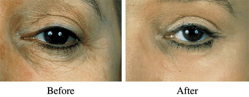 Laser Skin Rejuvenation Before and After