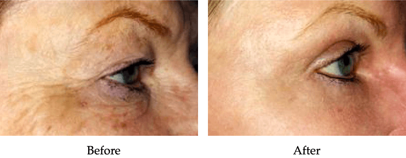 Upper Blepharoplasty Before and After