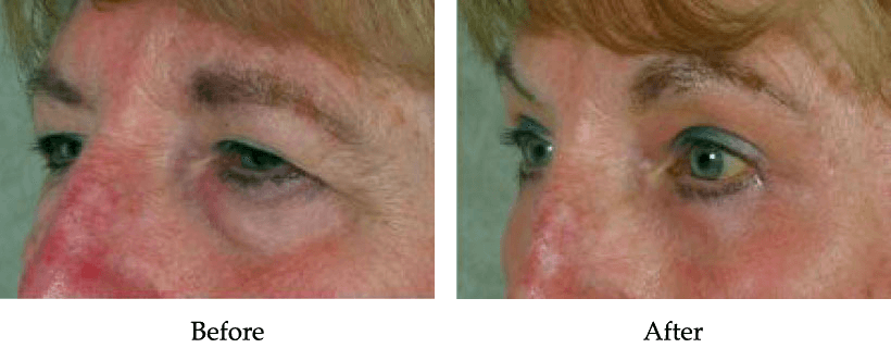 Upper Blepharoplasty Before and After