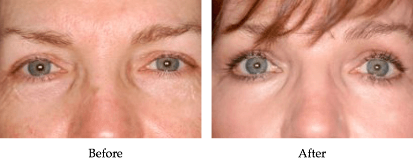 Upper Blepharoplasty Before and After