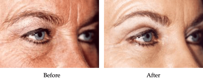Upper Blepharoplasty Before and After