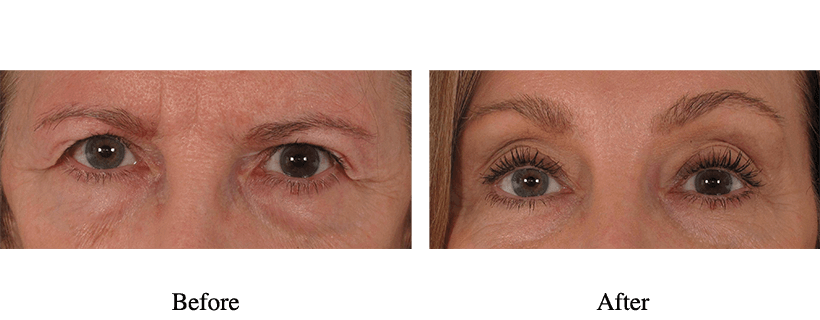 Brow Lift Before And After