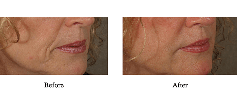 Juvederm Before & After