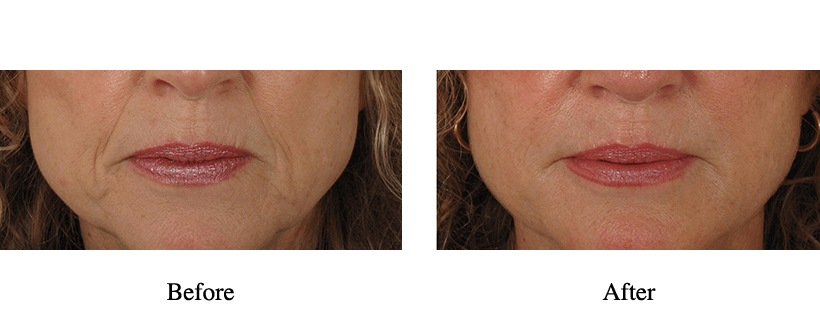 Juvederm Before & After