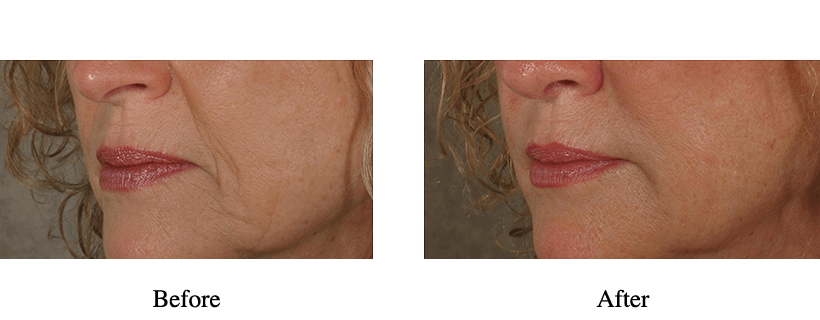 Juvederm Before & After