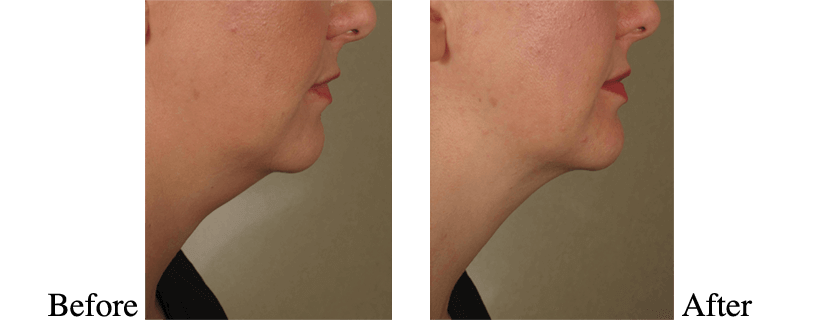 Kybella Profile