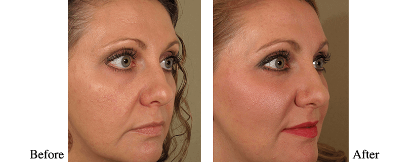 Liquid Facelift Before & After