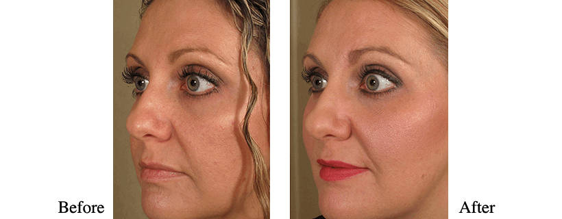 Liquid Facelift Before & After