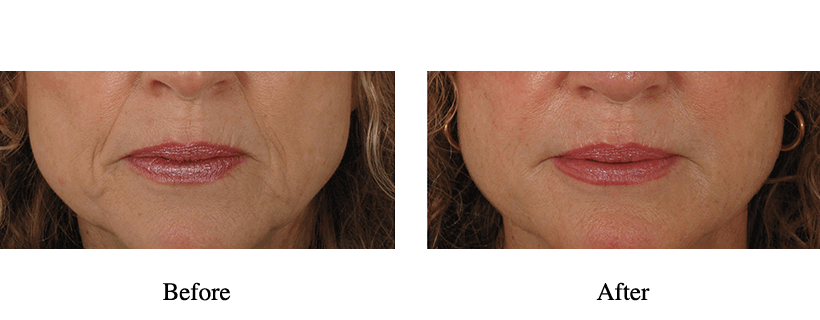 Liquid Facelift Before & After