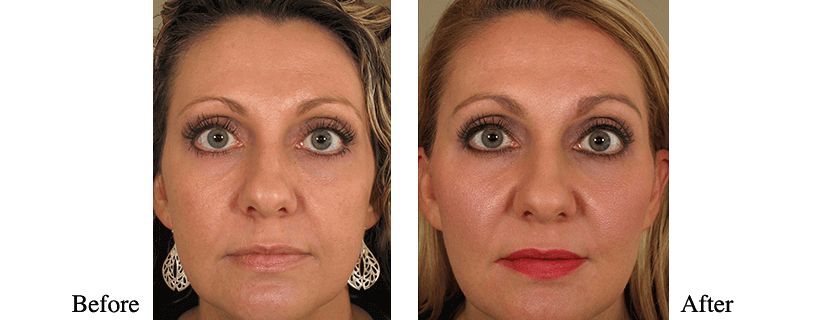 Liquid Facelift Before & After