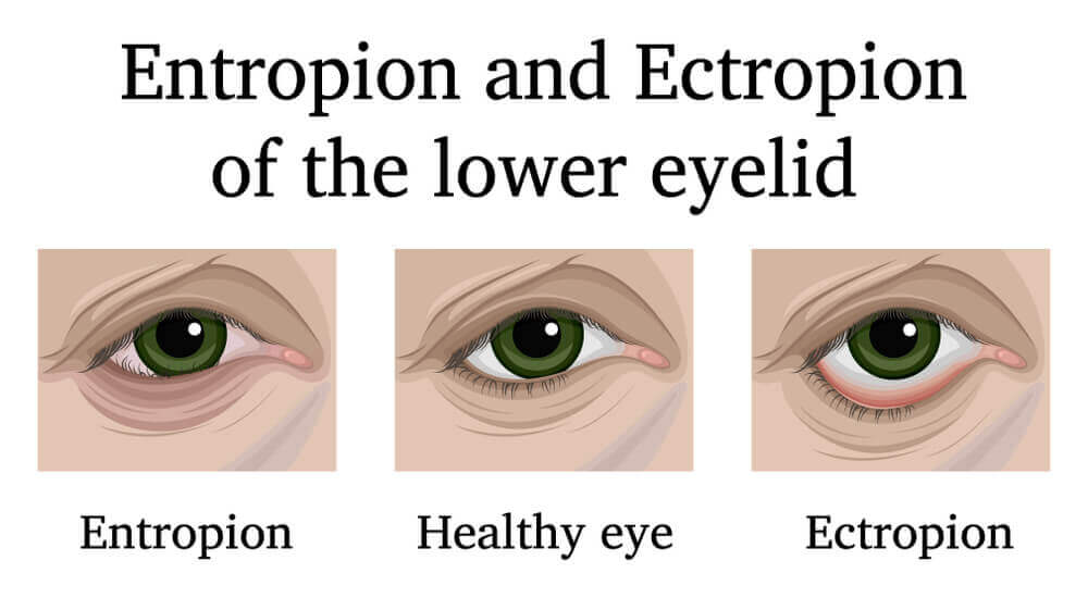 Illustration of Entropion and Ectropion
