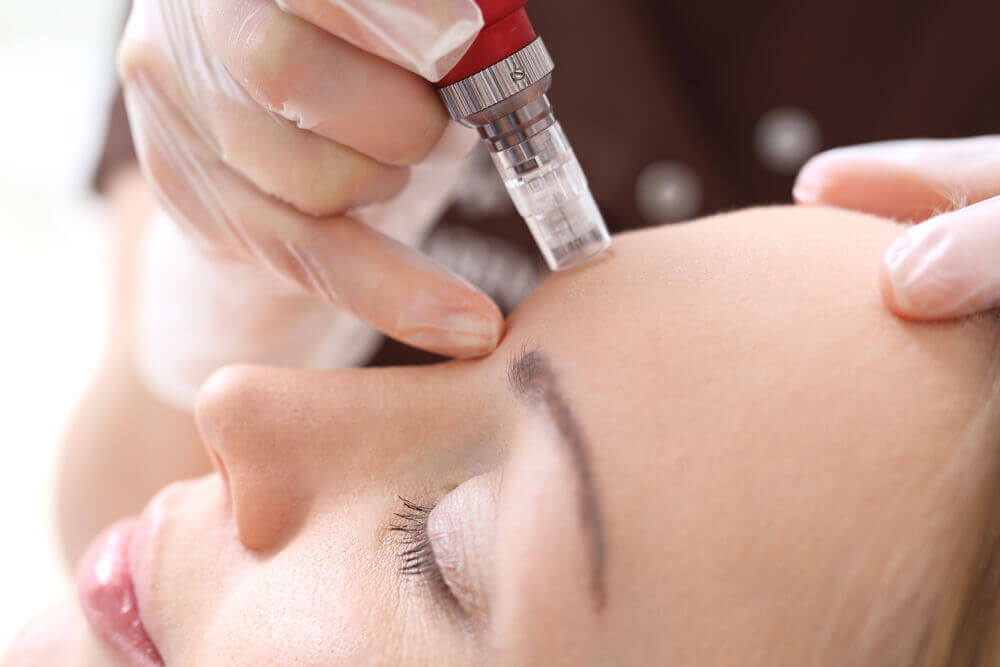 Woman getting a microneedling treatment