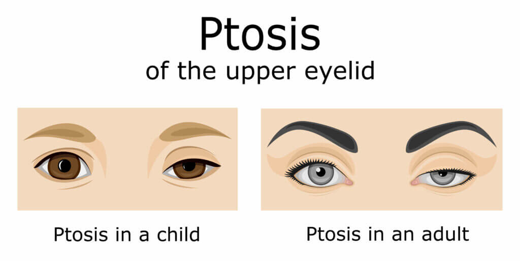 Ptosis illustration