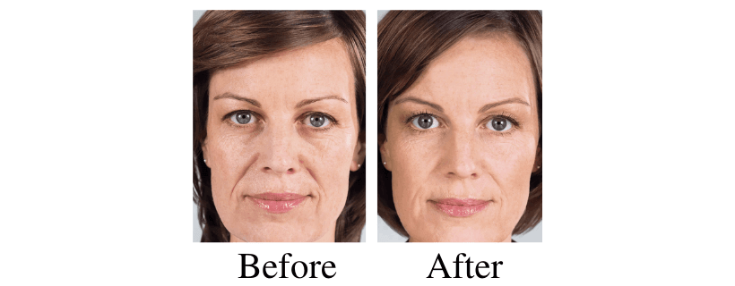 Sculptra before and after