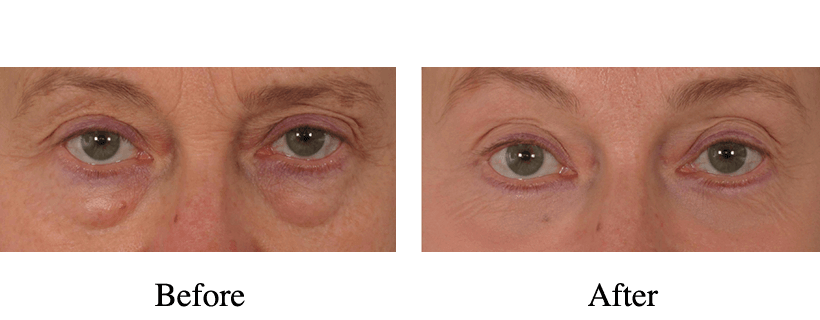 Under Eye Repair Before & After