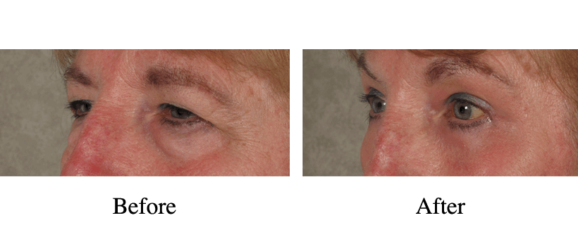 Under Eye Treatments Before & After