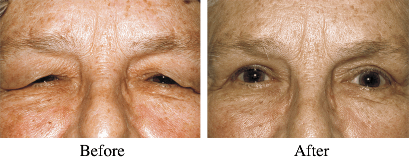 Upper Eye Blepharoplasty Before and After