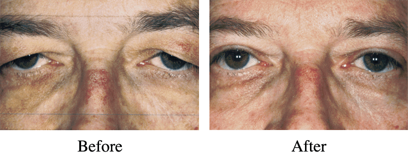 Upper Eye Blepharoplasty Before and After
